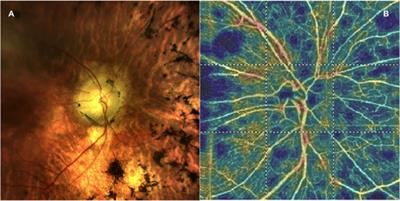 Radial Peripapillary Capillary Network in Patients with Retinitis Pigmentosa: An Optical Coherence Tomography Angiography Study